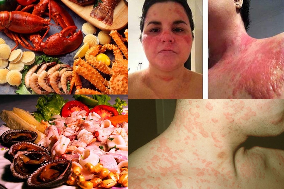cách chữa trị dị ứng hải sản