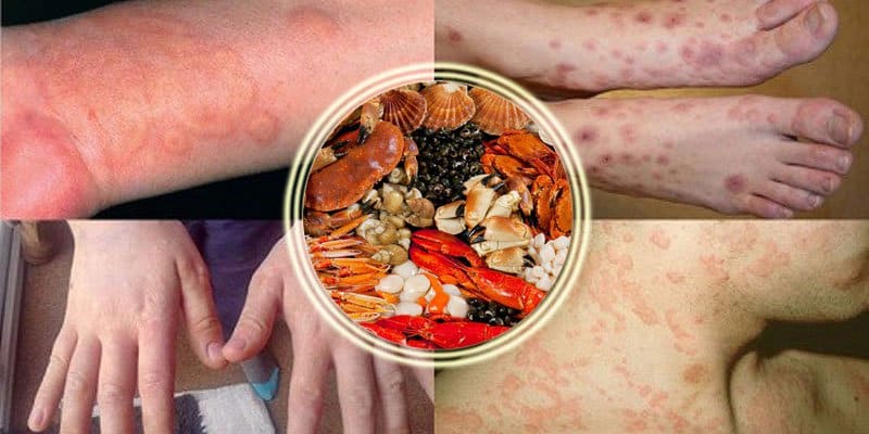 nguyên nhân dị ứng hải sản