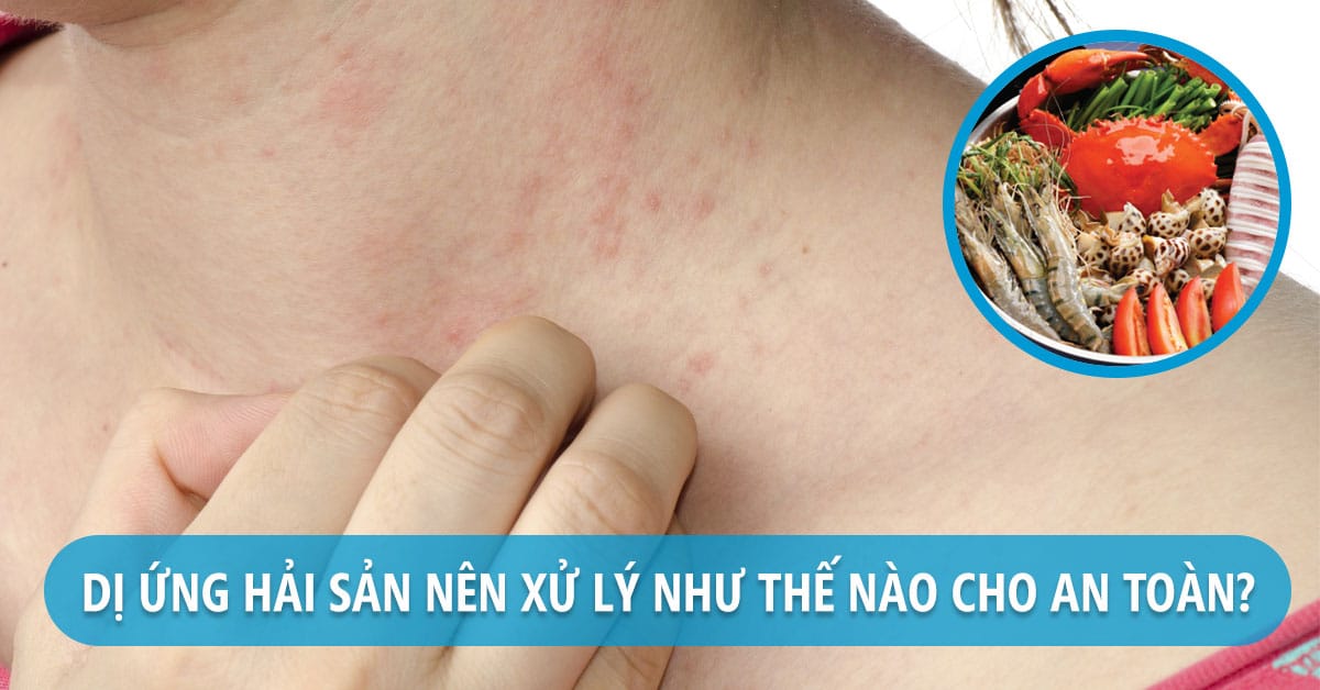 dị ứng hải sản